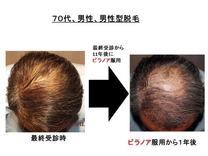 円形脱毛症　病院